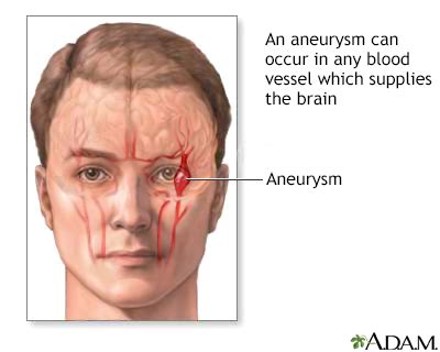 Aneurysm in the brain Information | Mount Sinai - New York