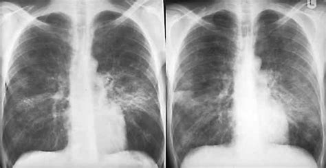 Pulmonary Edema X Ray Butterfly Pattern