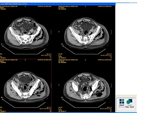 Fournier’s Gangrene – Medical and Surgical Considerations | IntechOpen