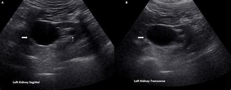 The Ultrasound Mimics of Hydronephrosis - Renal Fellow Network