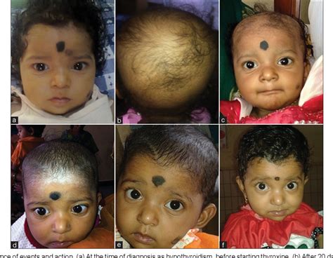 Figure 1 from Diffuse scalp hair loss due to levothyroxine overdose | Semantic Scholar