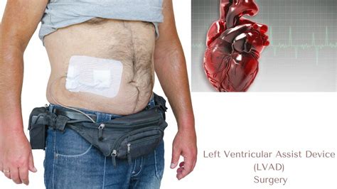 LVAD Surgery In India | Left Ventricular Assist Device Surgery Cost In India