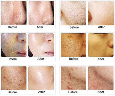 Lactic acid and Chemical peel on Pinterest