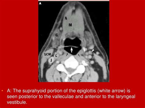 larynx Imaging 1st part laryngeal anatomy CT MRI Dr Ahmed Esawy