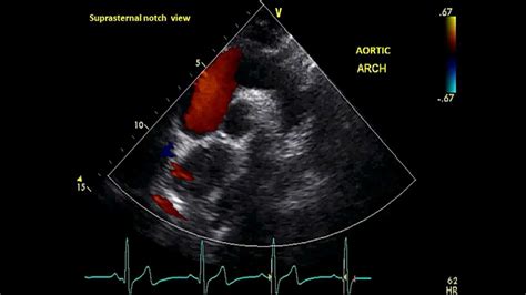 Subcostal Views - Transthoracic Echocardiogram (TTE) - YouTube