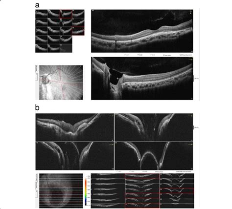 OCT images of the left eye. a. OCT examination of the true optic disc... | Download Scientific ...