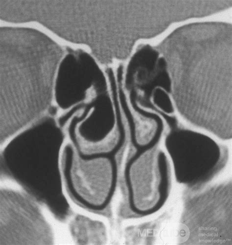 Concha Bullosa Pre-Op [CT scan] • Image • MEDtube.net