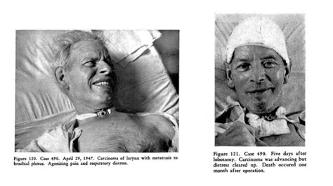 Lessons to be learnt from the history of lobotomy | Tidsskrift for Den norske legeforening