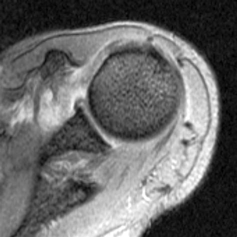 Glenohumeral Ligament Mri