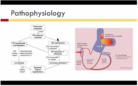 Pathophysiology Of Pulmonary Embolism - slideshare