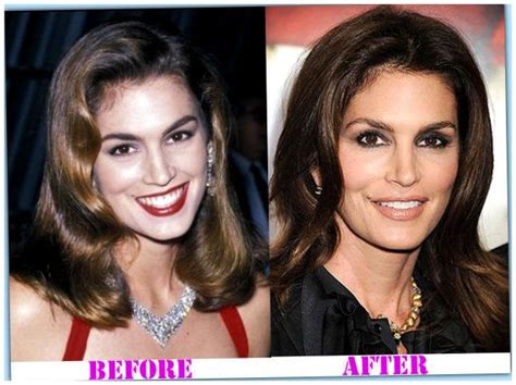 Cindy Crawford cosmetic surgery before and after photos ~ Celebrity Plastic Surgery News ...