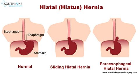 Hiatal Hernia- Causes, Types, Symptoms, Diagnose and Treatment | Texas