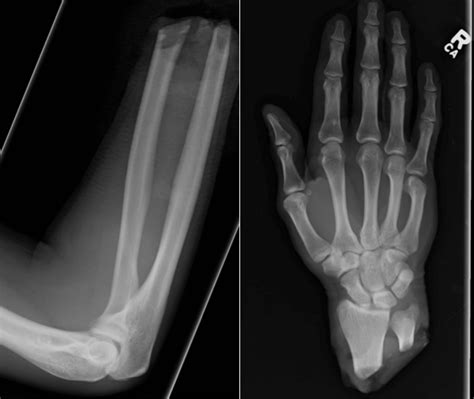 Traumatic amputation - Radiology at St. Vincent's University Hospital