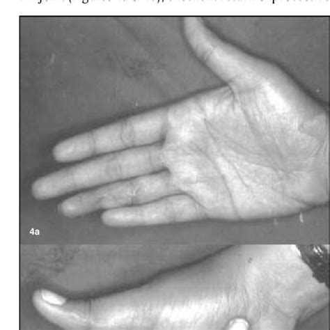 (Case No. 3) Ring avulsion injury with skeletal disruption through the... | Download Scientific ...