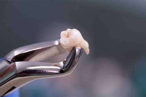 Is a Wisdom Tooth Extraction a Common Procedure? - King Dentistry ...