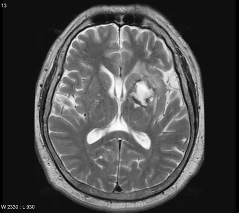 Hemorrhagic stroke MRI - wikidoc