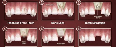 bone grafting – image credit Dear Doctor · Implantation Dental Center