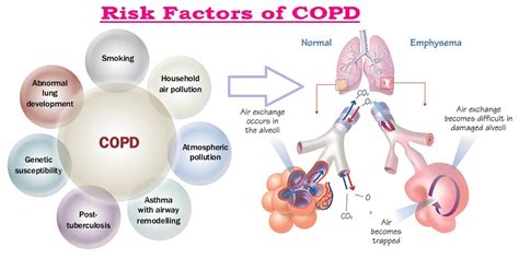 Chronic Obstructive Pulmonary Disease (COPD) - MedicoInfo