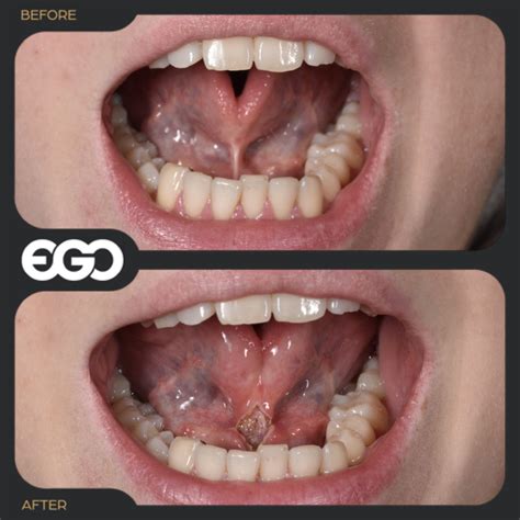 Laser Frenectomy – The Official EGO Dental Clinic Westminster