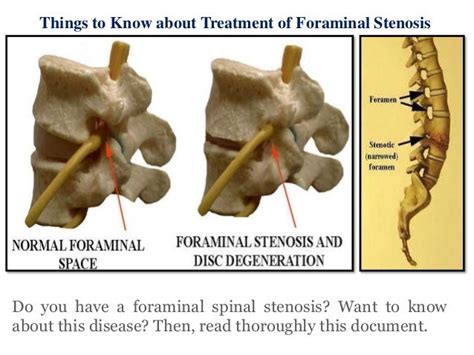 Treatment of foraminal stenosis