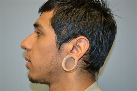 Gauged Earlobe Repair – Patients Before and After - Atlanta Plastic ...