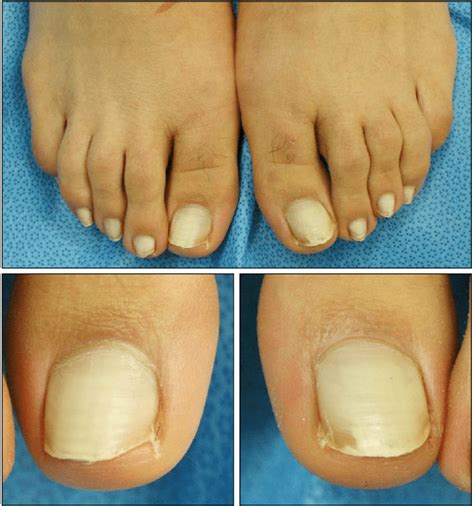 All toenails showed chalky white and opaque nail plates characteristic... | Download Scientific ...