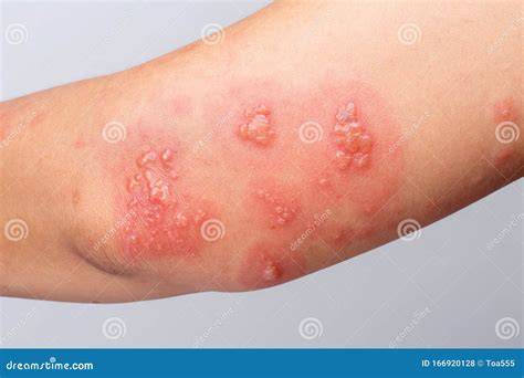 Shingles (herpes Zoster) Blister Skin Rash Royalty-Free Stock ...