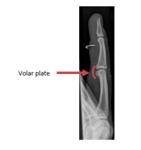 Hand Therapy - Volar Plate Injury of the Finger (PIFU) | Hull University Teaching Hospitals NHS ...