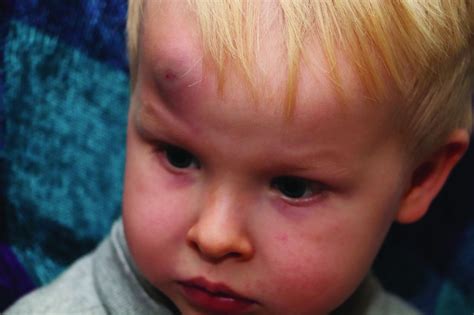 AAP adds specifics to policy on abusive head trauma | MDedge Pediatrics