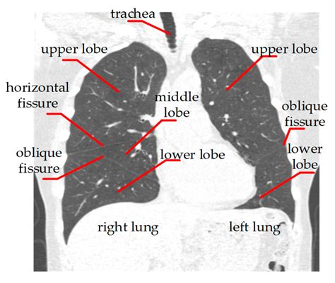 Radiopaedia Lung Segments