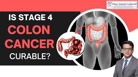 Is Stage 4 colon cancer curable? #coloncancer | Dr. Vinay Samuel Gaikwad - Surgical Oncologist ...