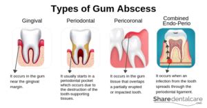 Gum Abscess: Symptoms, Causes, & Treatment - Share Dental Care