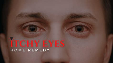 Natural Relief: Discover The Best Itchy Eyes Home Remedies