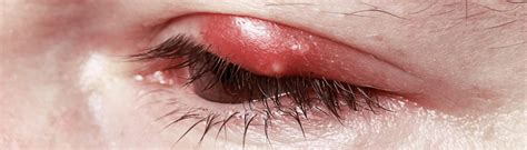 Blepharitis | healthdirect