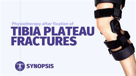 Physiotherapy after Tibia Plateau Fracture Fixation | SYNOPSIS - YouTube