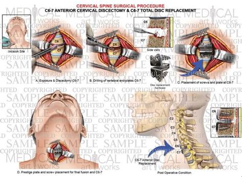 C6 Disc Replacement Surgery | 1 Level - C6-C7 anterior cervical ...