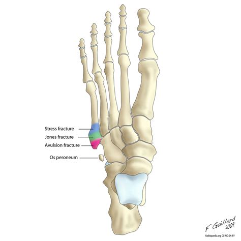 Fractures of the proximal 5th metatarsal | Radiology Case | Radiopaedia.org | Jones fracture ...