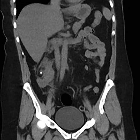 Coronal and transverse CT showing a malrotated right kidney with a... | Download Scientific Diagram