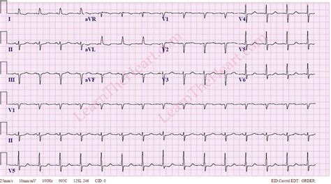 Left anterior fascicular block | LearntheHeart.com