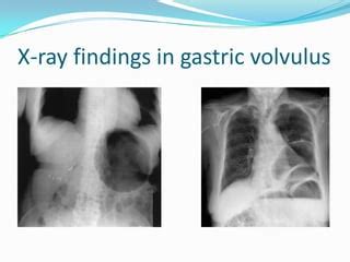 Gastric volvulus and other types of volvulus | PPT