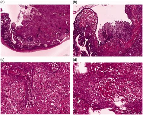 Microscopic findings in the left ovary. (a) A mucinous borderline tumor... | Download Scientific ...