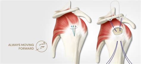 Arthroscopic Rotator Cuff Repair surgery, rotator cuff specialist in Indore