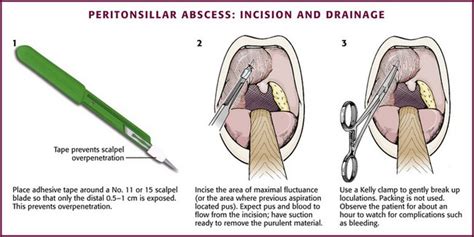 Otolaryngologic Procedures | Veterian Key