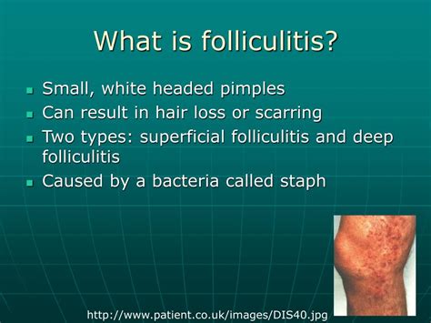 PPT - Folliculitis by: Nicole Pitt PowerPoint Presentation, free download - ID:5070101