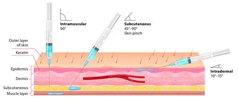 Angle Of Needle For Intramuscular Injection at Doris Glenn blog