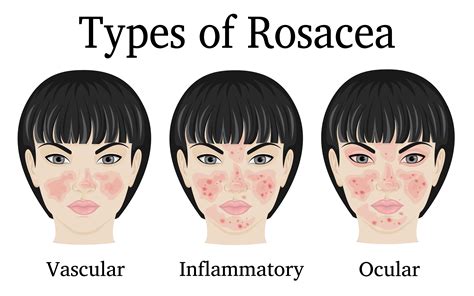 Rosacea Nose