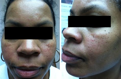 Acne and Rosacea: A Closer Look at Skin of Color