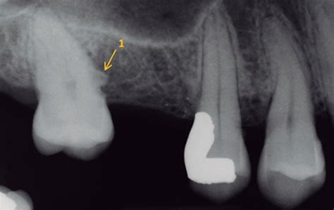 Cervical Enamel Projection