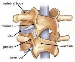 Transforaminal Lumbar Interbody Fusion at best price in Raigad | ID: 10823510162