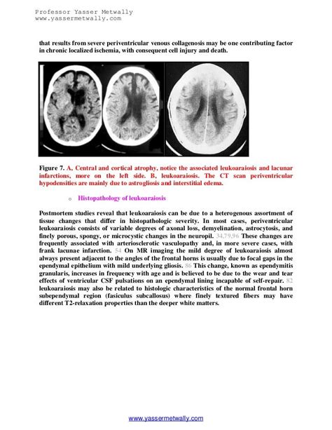 Topic of the month...The ischemic microvascular brain disease